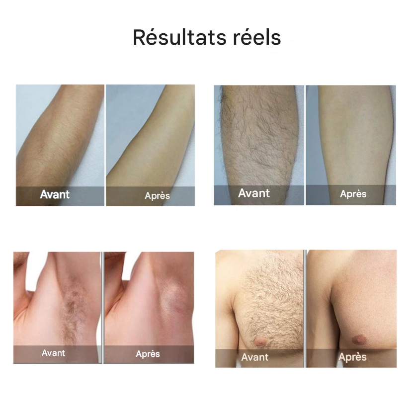 Epilateur Laser Portable IPL